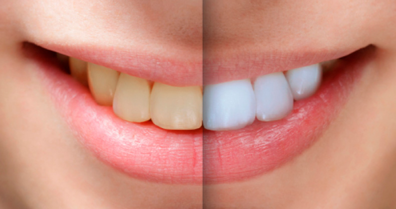 Comparação de sorriso antes e depois do clareamento dental