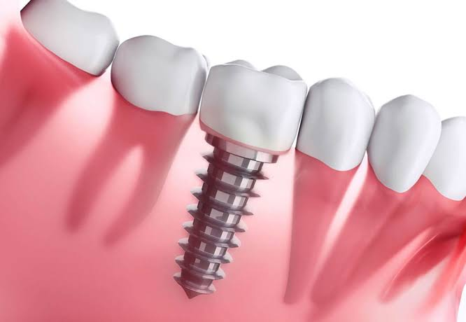 Ilustração de implante dentário parafusado no osso, entre dentes naturais