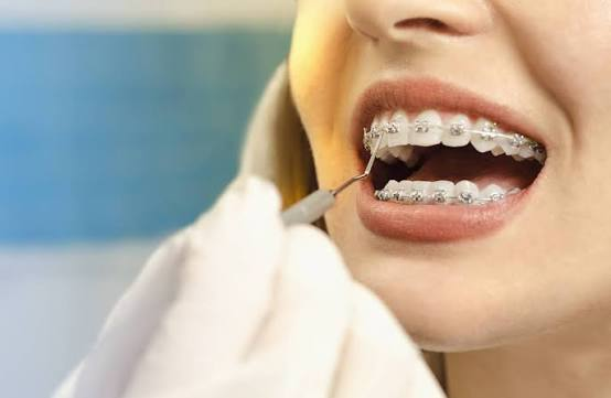 Close-up de aparelho ortodôntico fixo nos dentes